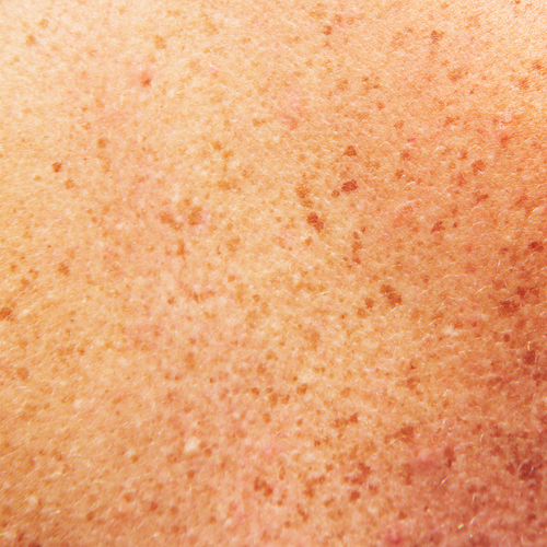 what causes dark spots